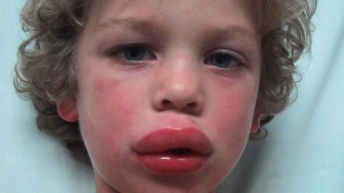 Allergic Reaction to Food Coloring Symptoms